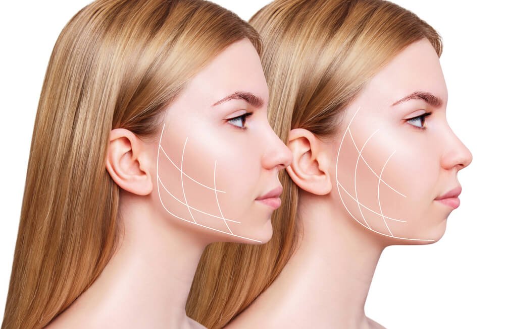 Jawline Çene Dolgusu
